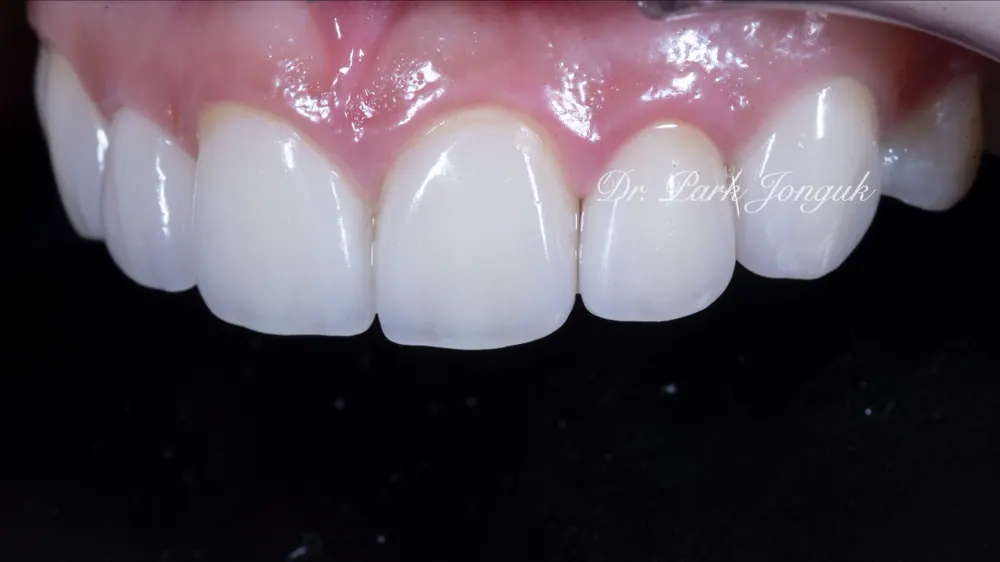Veneer cho răng to: Răng to vẫn OK — ảnh 8