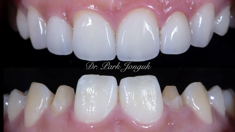 Veneer cho răng to: Răng to vẫn OK — ảnh 9