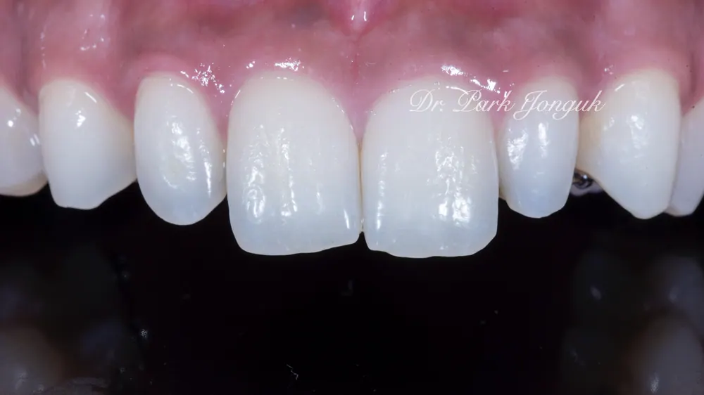 Trước điều trị