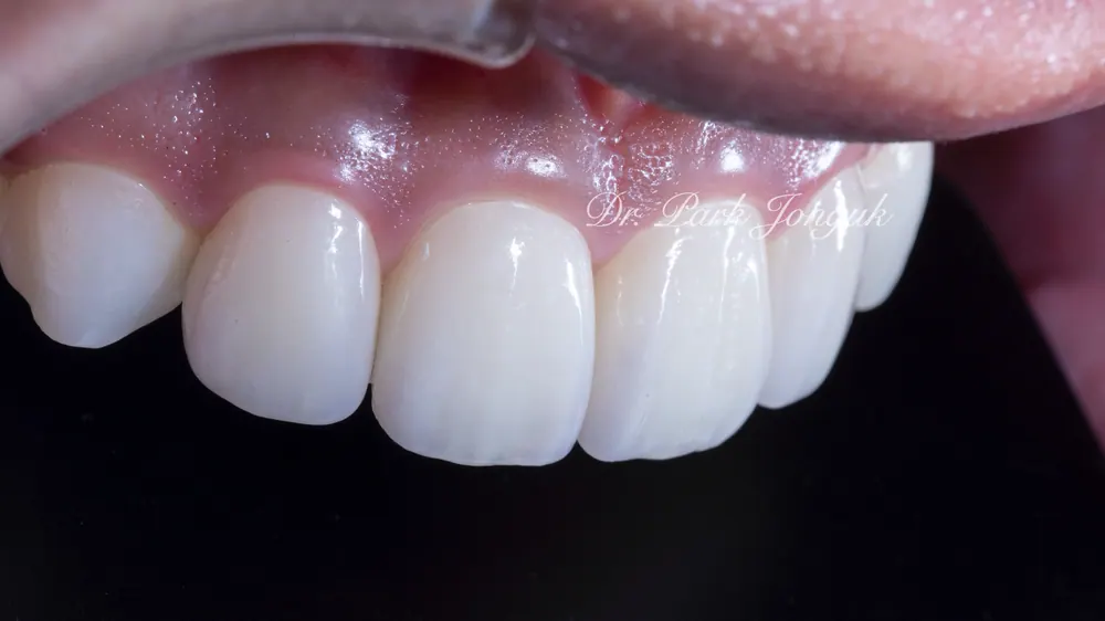 Xem ảnh trước sau của nhiều ca Veneer đa dạng, phần 2 — ảnh 3