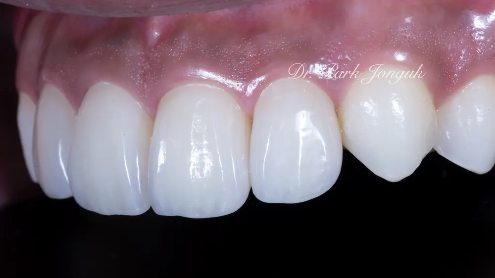 Xem ảnh trước sau của nhiều ca Veneer đa dạng, phần 2 — ảnh 4