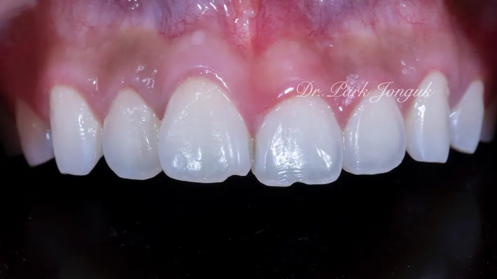 Trước điều trị