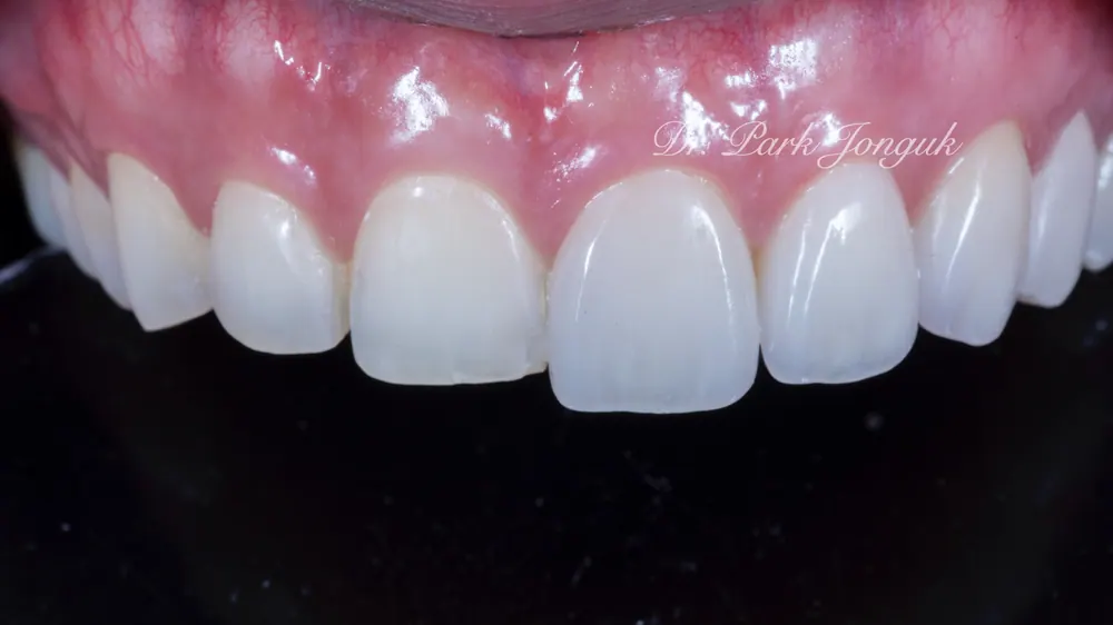 Veneer không mài răng