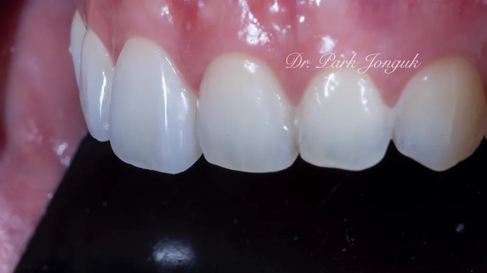 Xem ảnh trước sau của nhiều ca Veneer đa dạng, phần 2 — ảnh 9