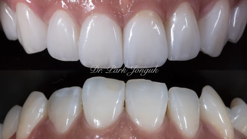 Xem ảnh trước sau của nhiều ca Veneer đa dạng, phần 2 — ảnh 11
