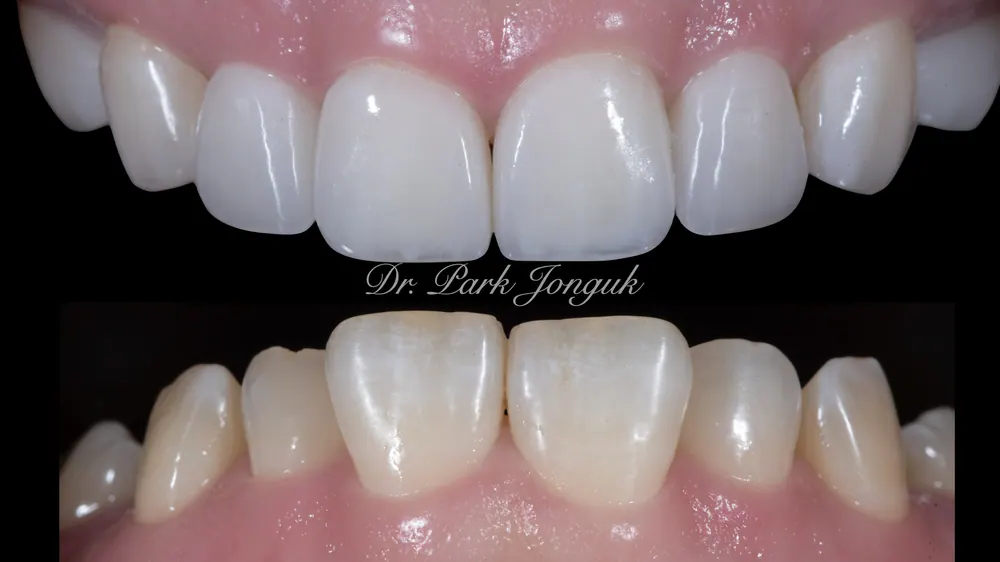 Xem ảnh trước sau của nhiều ca Veneer đa dạng, phần 2 — ảnh 19