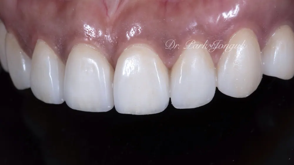 Xem ảnh trước sau của nhiều ca Veneer đa dạng, phần 2 — ảnh 23