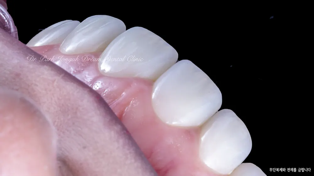 Xem ảnh trước sau của nhiều ca Veneer đa dạng, phần 2 — ảnh 28