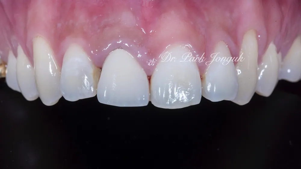 What Matters When Combining All-Ceramic Crowns and Veneers — photo 1