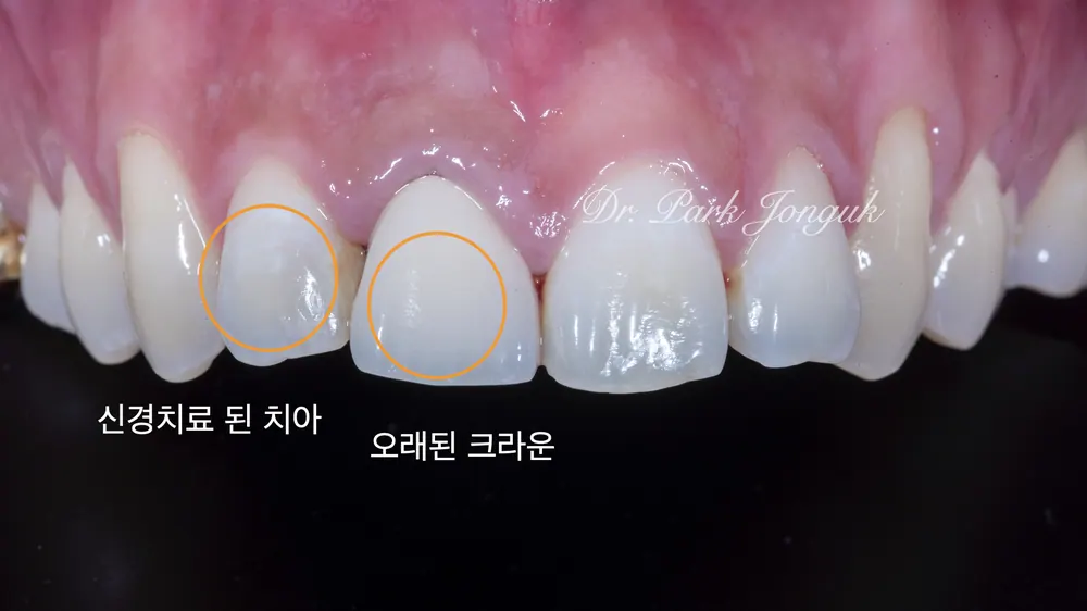 What Matters When Combining All-Ceramic Crowns and Veneers — photo 2