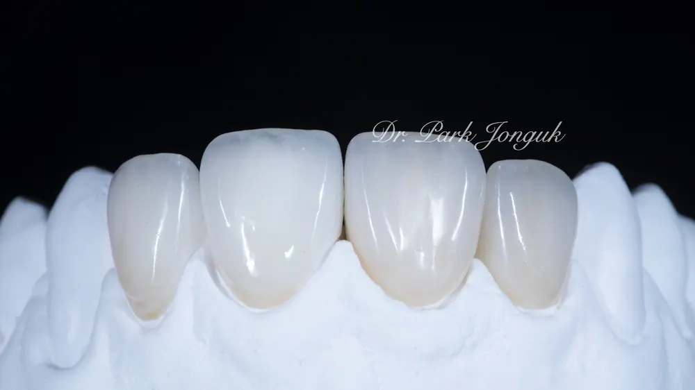What Matters When Combining All-Ceramic Crowns and Veneers — photo 3