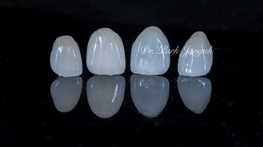 What Matters When Combining All-Ceramic Crowns and Veneers — photo 4