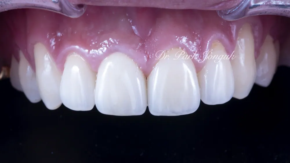 What Matters When Combining All-Ceramic Crowns and Veneers — photo 5