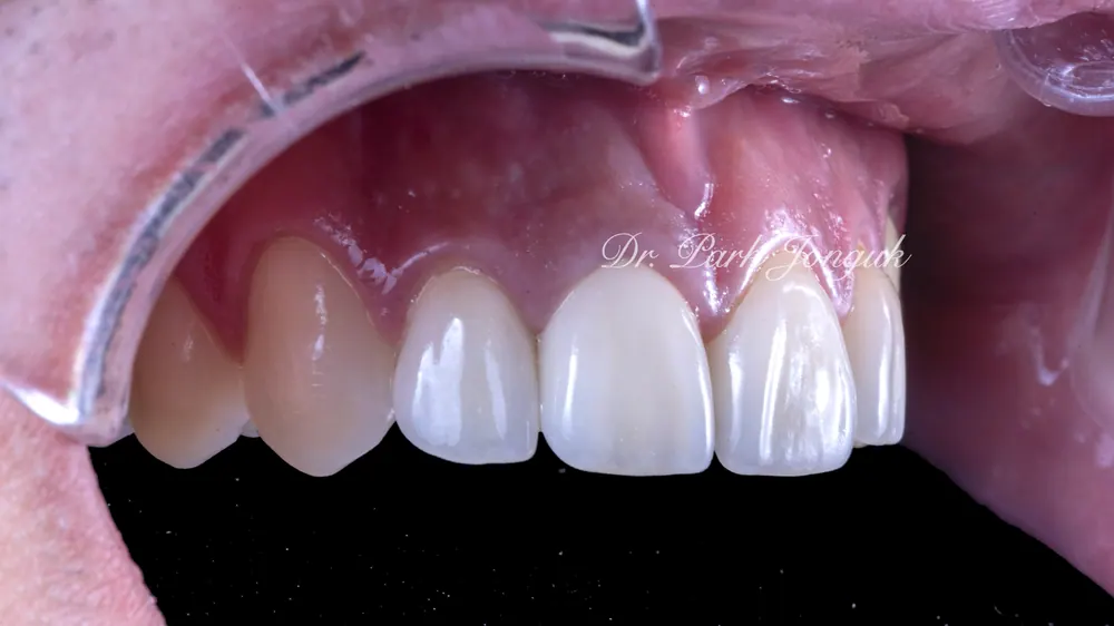 What Matters When Combining All-Ceramic Crowns and Veneers — photo 6