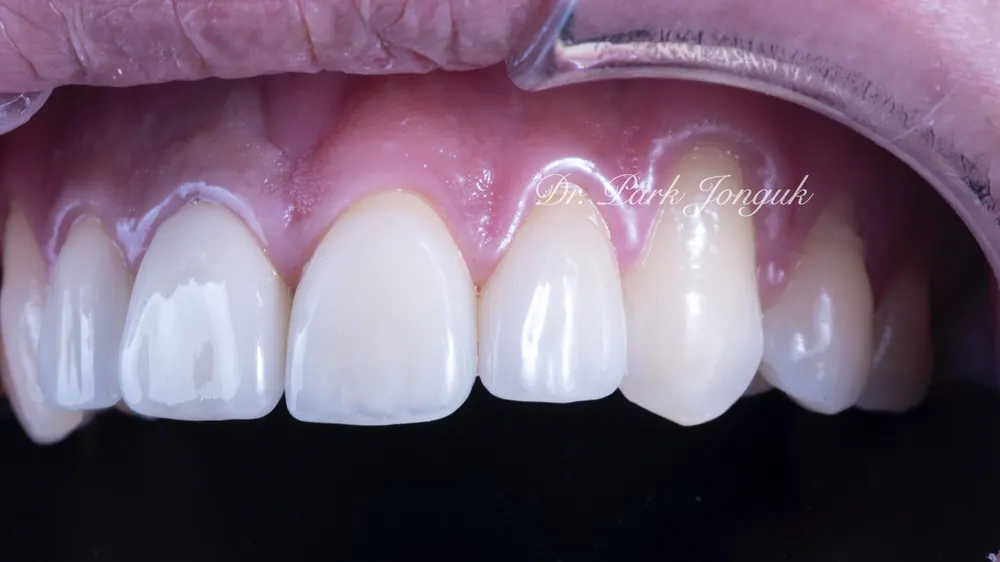 What Matters When Combining All-Ceramic Crowns and Veneers — photo 7