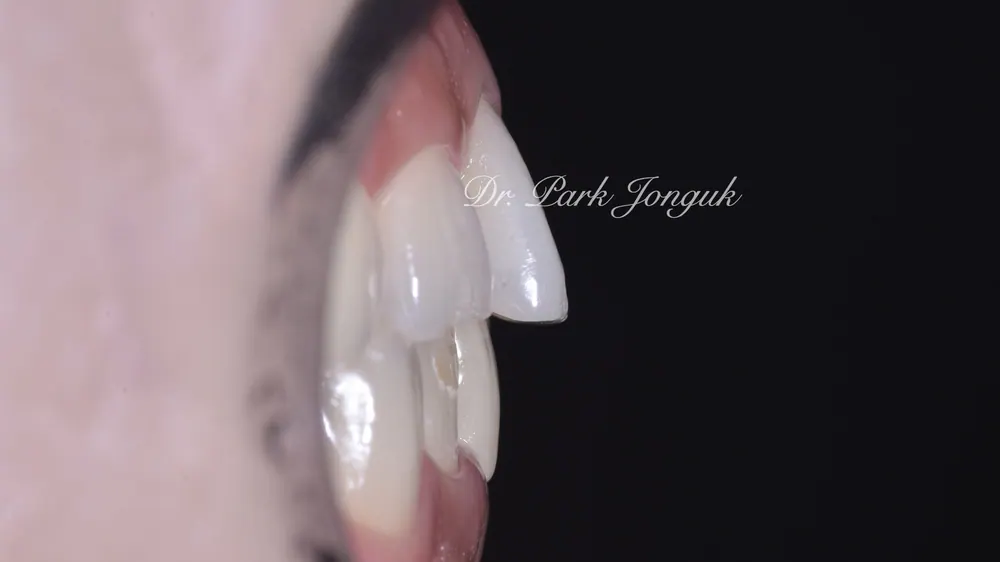 Gangnam Veneers: A Treatment Case for Protruding, Crowded Teeth — photo 2