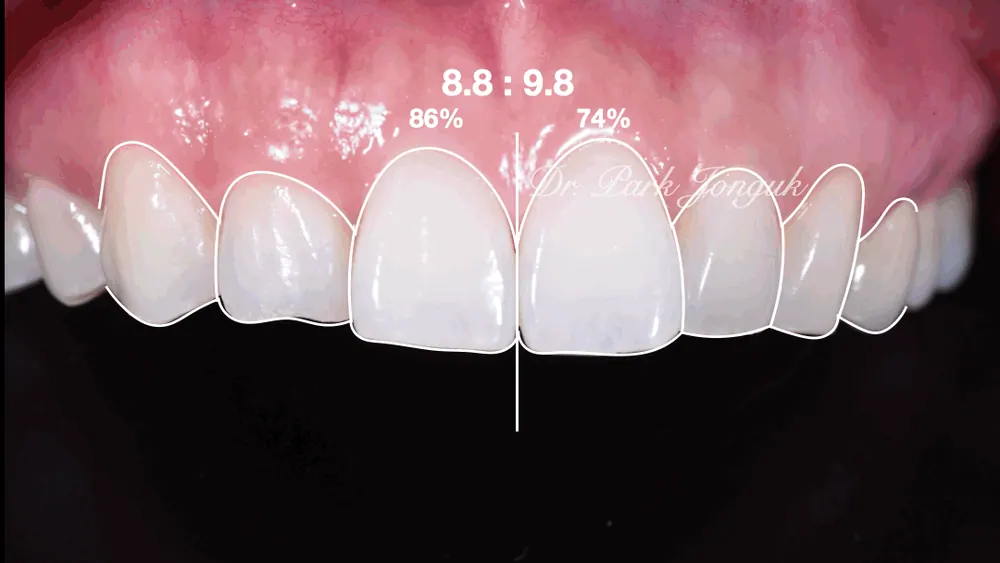 Gangnam Veneers: A Treatment Case for Protruding, Crowded Teeth — photo 4