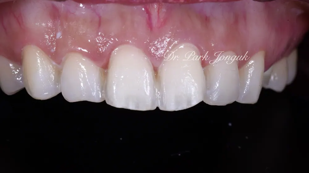 Gangnam Veneers: A Treatment Case for Protruding, Crowded Teeth — photo 5