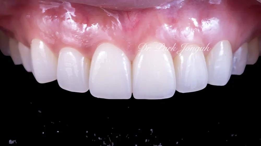 Gangnam Veneers: A Treatment Case for Protruding, Crowded Teeth — photo 6