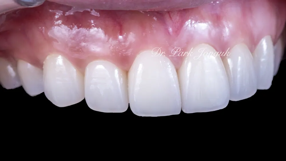 Gangnam Veneers: A Treatment Case for Protruding, Crowded Teeth — photo 7