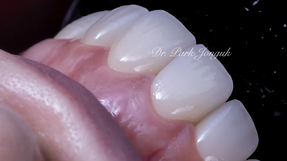 Gangnam Veneers: A Treatment Case for Protruding, Crowded Teeth — photo 8