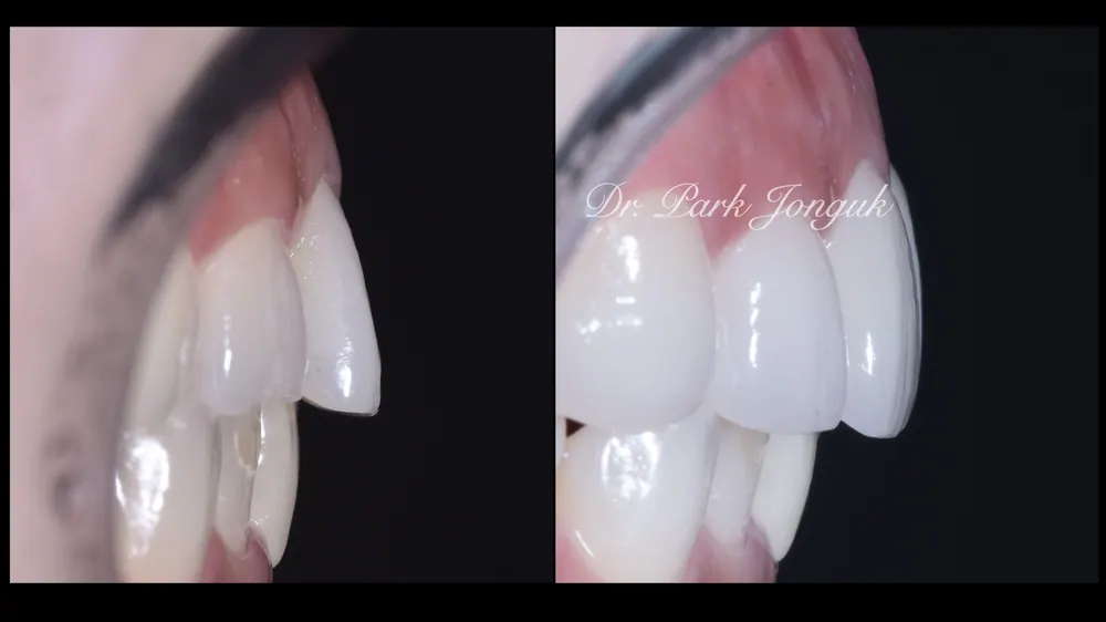 Gangnam Veneers: A Treatment Case for Protruding, Crowded Teeth — photo 9
