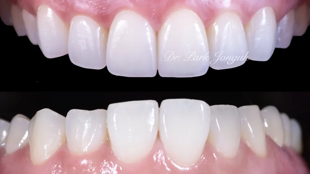 Gangnam Veneers: A Treatment Case for Protruding, Crowded Teeth — photo 10