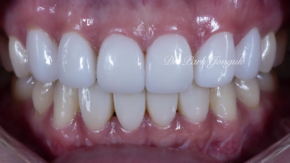 Naturally Retreating Artificial-Looking, Awkward Veneers — photo 1