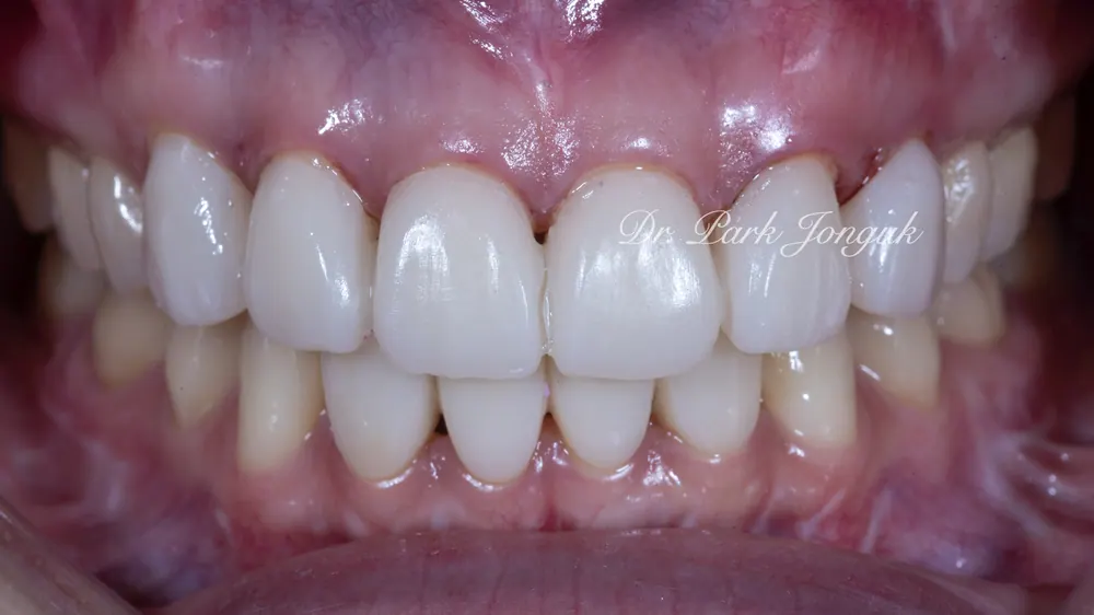 Naturally Retreating Artificial-Looking, Awkward Veneers — photo 5