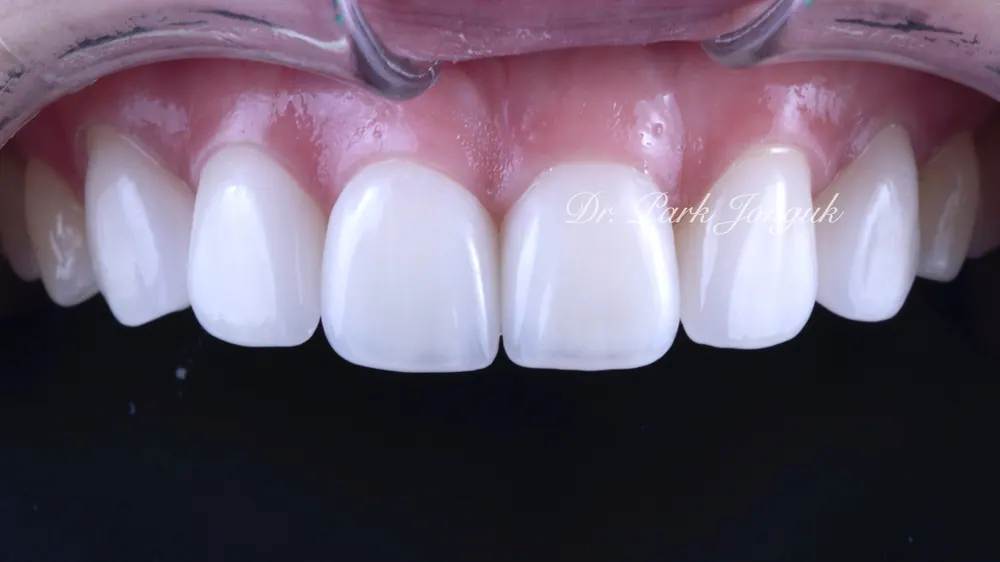 Naturally Retreating Artificial-Looking, Awkward Veneers — photo 6