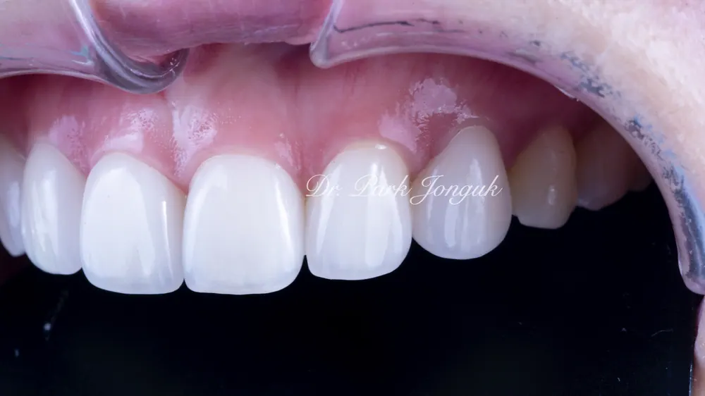 Naturally Retreating Artificial-Looking, Awkward Veneers — photo 8