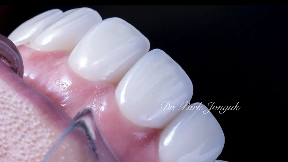Naturally Retreating Artificial-Looking, Awkward Veneers — photo 9