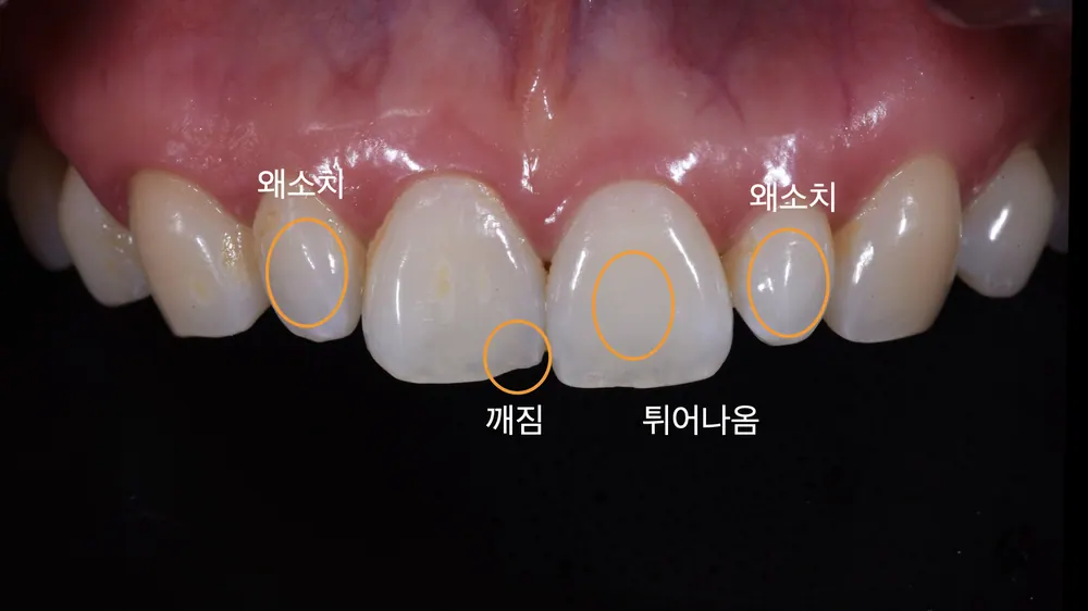 라미네이트치료 튀어나오고 큰 치아 치료한 사례 본문 사진 2