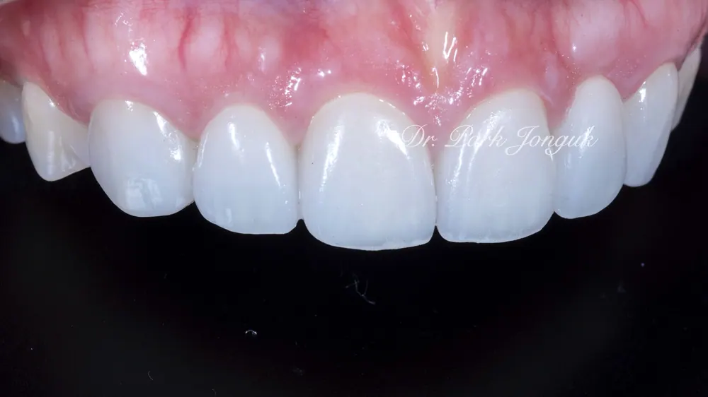 Before-and-After Photos: Gapped Teeth, No-Prep Veneers, Retreatment — Veneers and All-Ceramic Crowns — photo 3