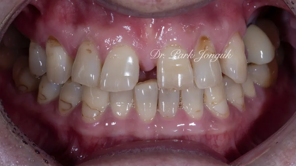 Before-and-After Photos: Gapped Teeth, No-Prep Veneers, Retreatment — Veneers and All-Ceramic Crowns — photo 5