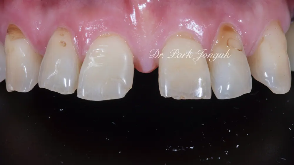 Before-and-After Photos: Gapped Teeth, No-Prep Veneers, Retreatment — Veneers and All-Ceramic Crowns — photo 6