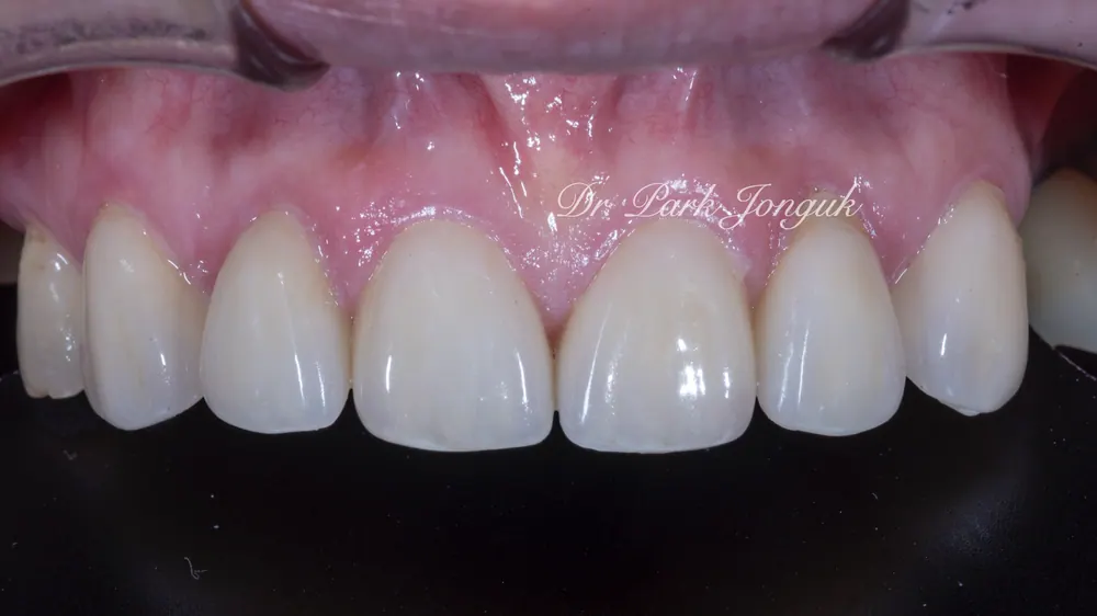 Before-and-After Photos: Gapped Teeth, No-Prep Veneers, Retreatment — Veneers and All-Ceramic Crowns — photo 7