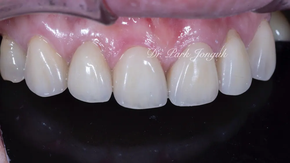 Before-and-After Photos: Gapped Teeth, No-Prep Veneers, Retreatment — Veneers and All-Ceramic Crowns — photo 8