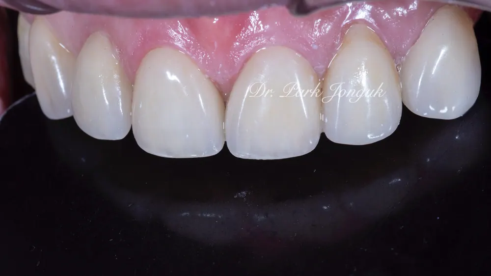 Before-and-After Photos: Gapped Teeth, No-Prep Veneers, Retreatment — Veneers and All-Ceramic Crowns — photo 9