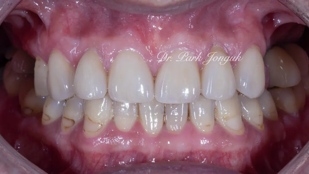 Before-and-After Photos: Gapped Teeth, No-Prep Veneers, Retreatment — Veneers and All-Ceramic Crowns — photo 10