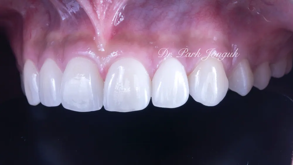 Before-and-After Photos: Gapped Teeth, No-Prep Veneers, Retreatment — Veneers and All-Ceramic Crowns — photo 16