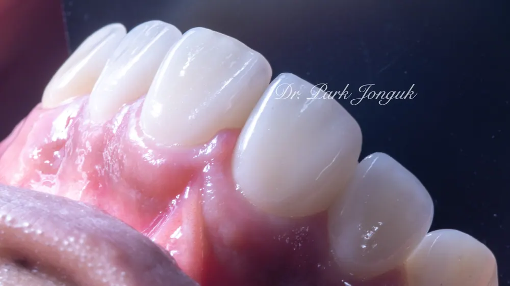 Before-and-After Photos: Gapped Teeth, No-Prep Veneers, Retreatment — Veneers and All-Ceramic Crowns — photo 17