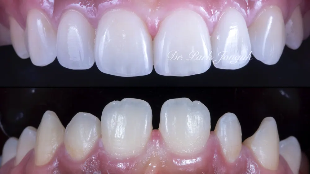 Before-and-After Photos: Gapped Teeth, No-Prep Veneers, Retreatment — Veneers and All-Ceramic Crowns — photo 18