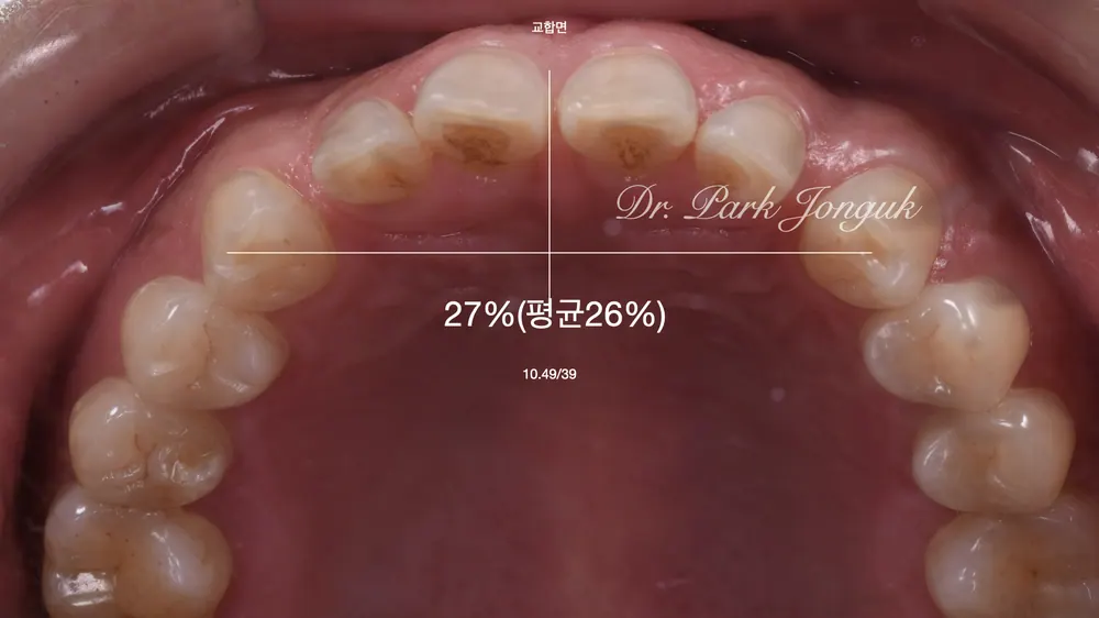 무삭제 라미네이트를 이용한 치아성형 본문 사진 4