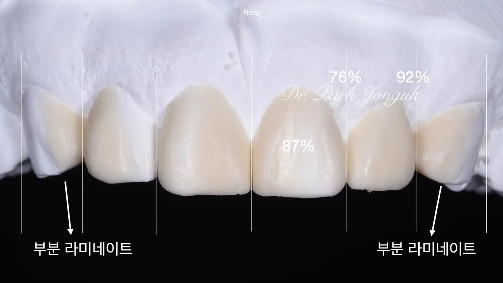 무삭제 라미네이트를 이용한 치아성형 본문 사진 6