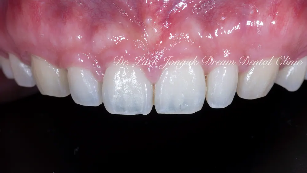 Cheongdam-dong Veneers, Done Without Any Tooth Reduction — photo 1