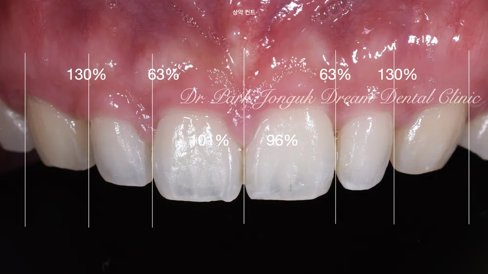 Cheongdam-dong Veneers, Done Without Any Tooth Reduction — photo 2