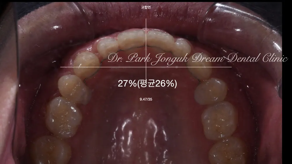 Cheongdam-dong Veneers, Done Without Any Tooth Reduction — photo 3