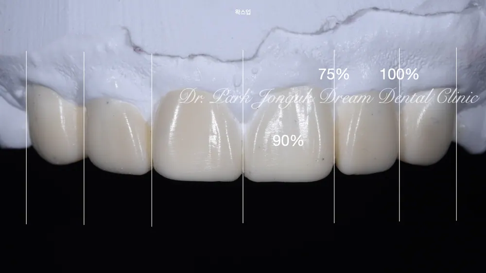 Cheongdam-dong Veneers, Done Without Any Tooth Reduction — photo 4