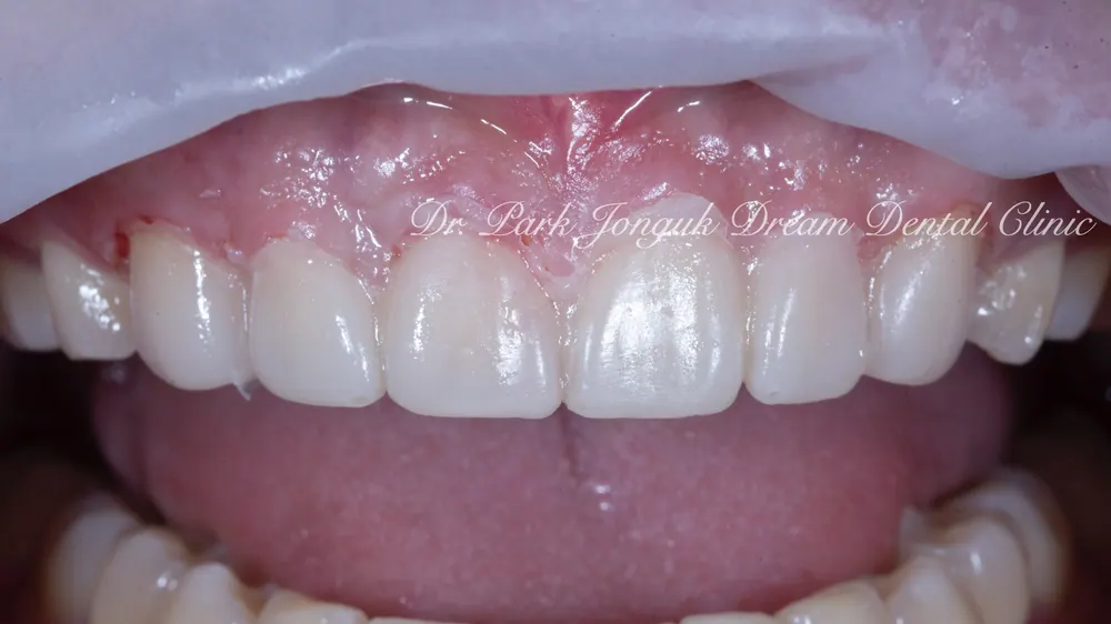 Cheongdam-dong Veneers, Done Without Any Tooth Reduction — photo 5